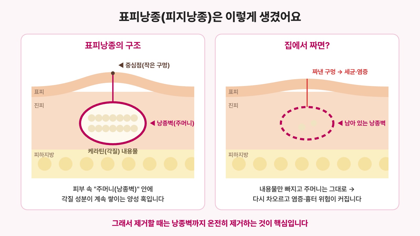 관악구 피지낭종 레이디유외과 - 표피낭종 구조와 짜면 재발하는 이유 그림